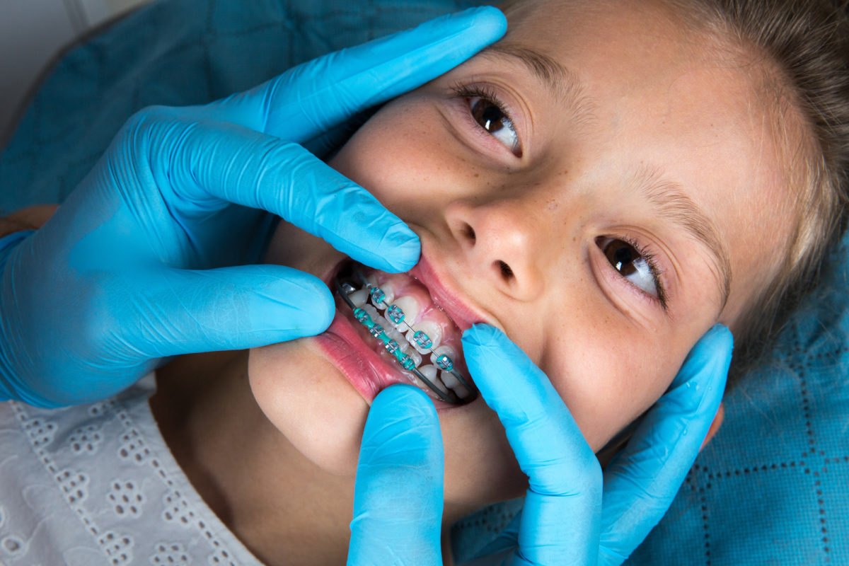 تقويم الأسنان للاطفال من عمر كم
